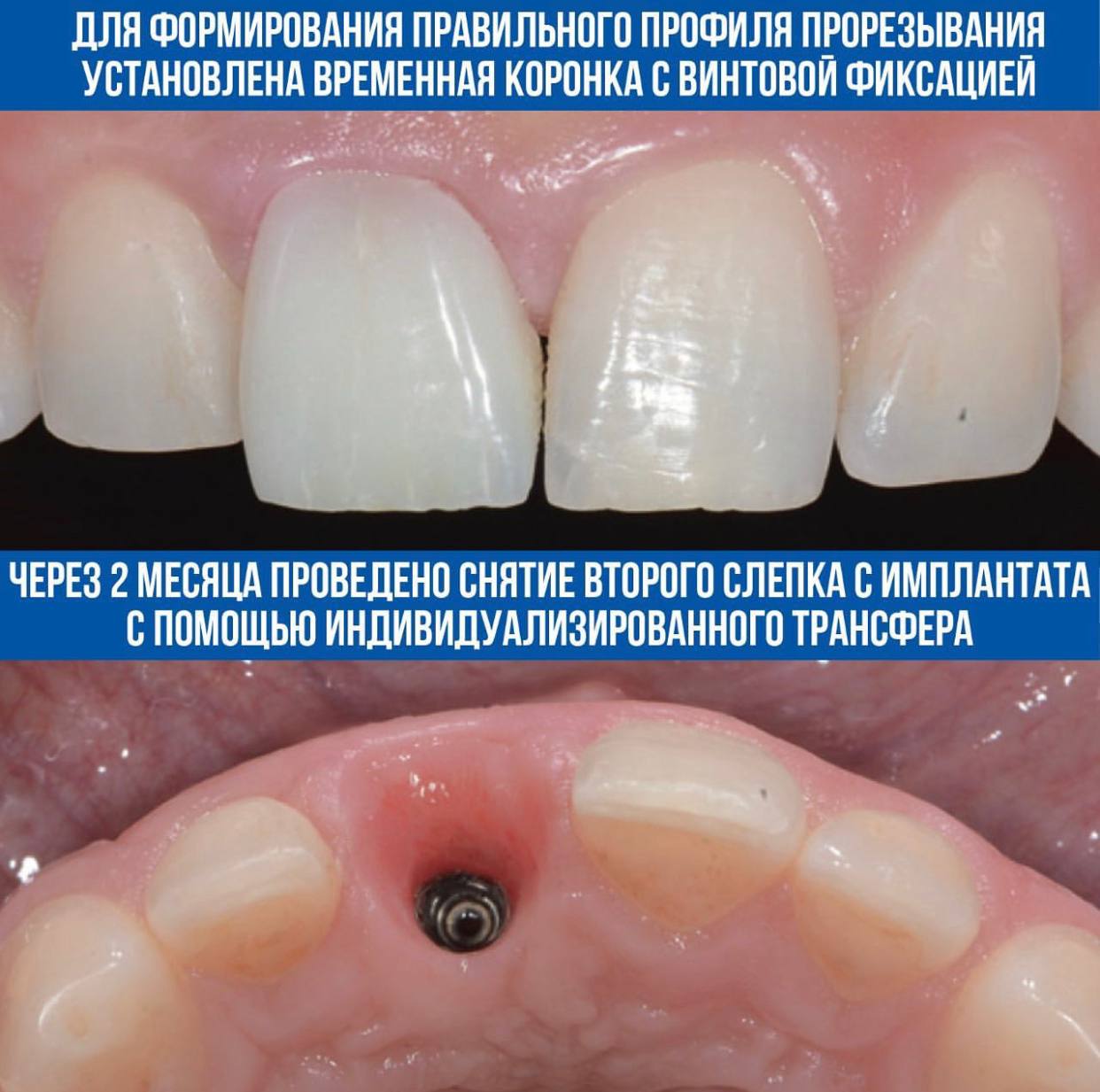 Техника L-shape. Клинический случай Рональда Юнга